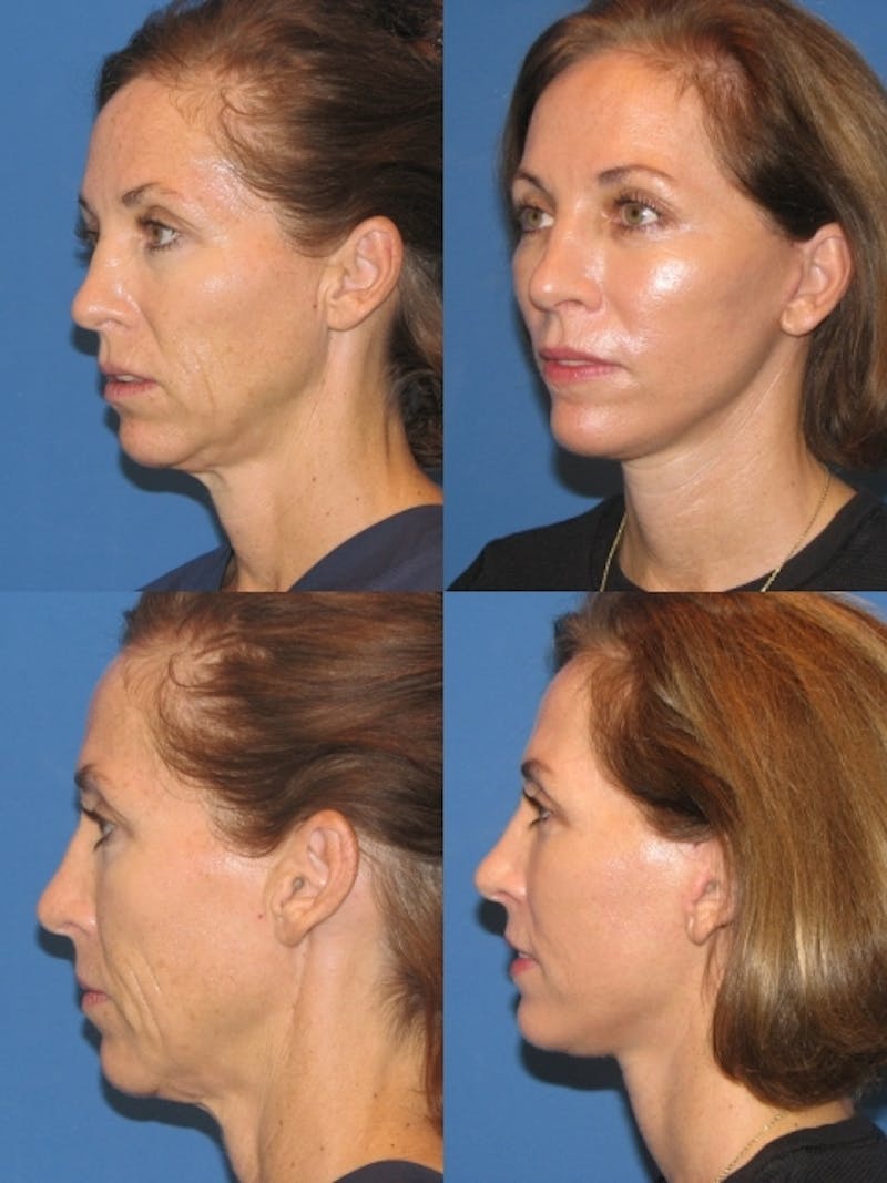 C02 Laser Rejuvenation Before & After Gallery - Patient 273799 - Image 1