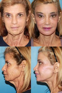 C02 Laser Rejuvenation Before & After Gallery - Patient 179001 - Image 1