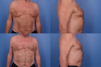 Coolsculpting Elite Before & After Gallery - Patient 290777 - Image 1
