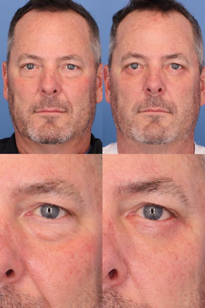 Lower Blepharoplasty Photo Gallery Before & After Gallery - Patient 223172 - Image 1