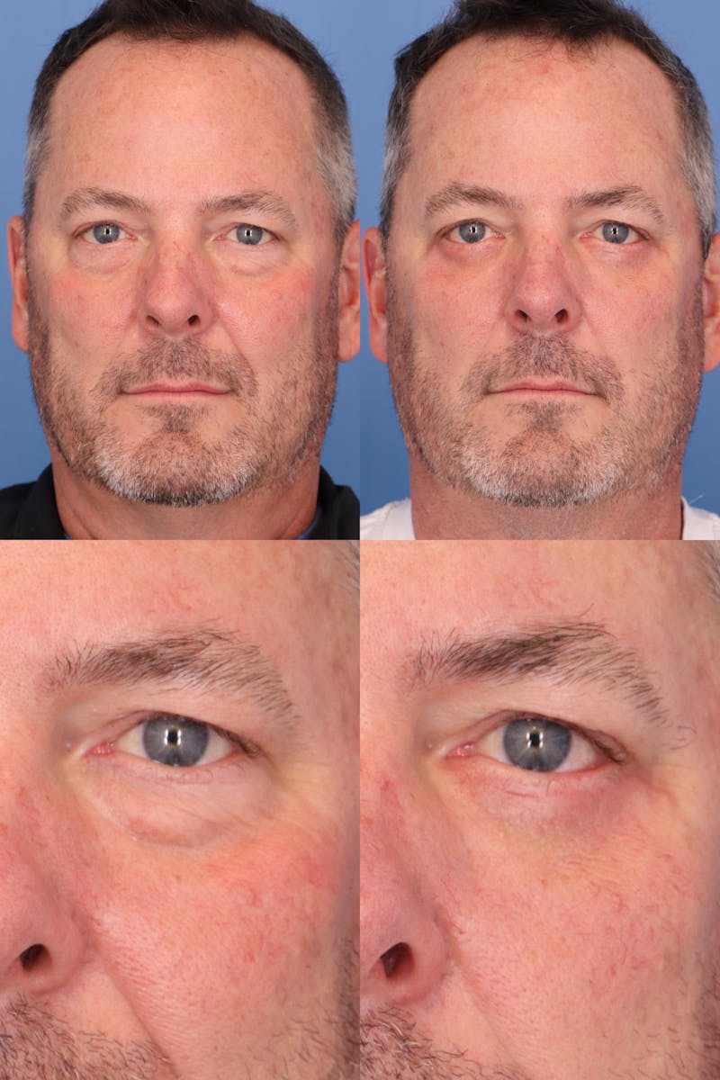 Lower Blepharoplasty Photo Gallery Before & After Gallery - Patient 223172 - Image 1