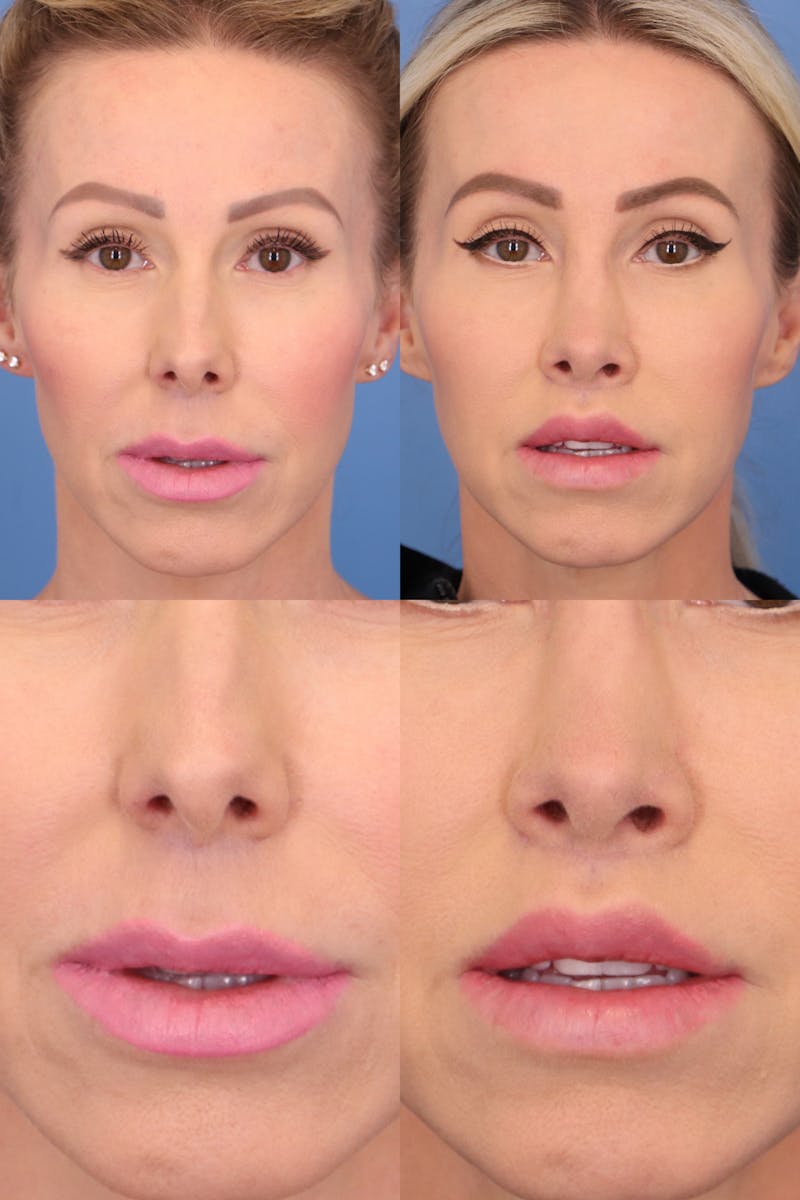 Patient 332111 Lip Lift Before and After Ranch & Coast Plastic Surgery