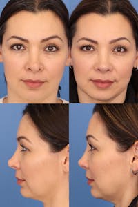 Female Revision Rhinoplasty Before & After Gallery - Patient 371433 - Image 1