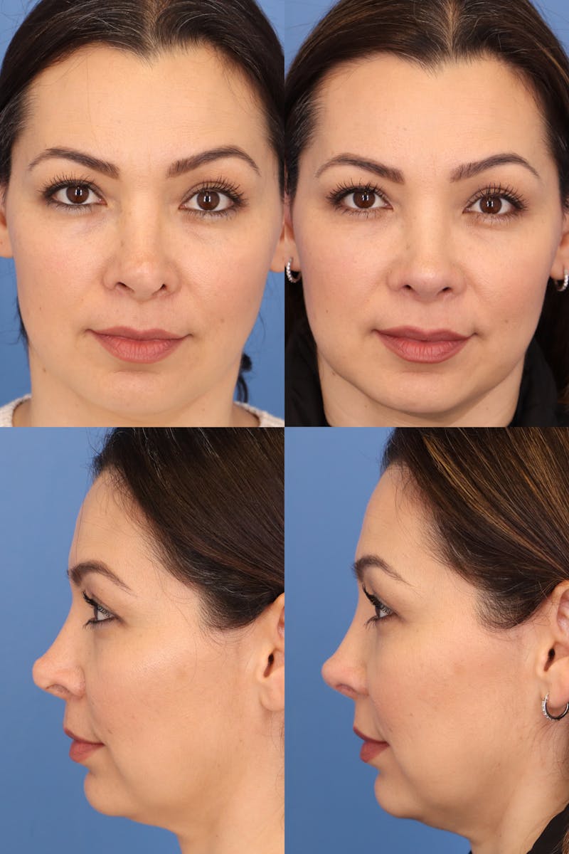 Female Revision Rhinoplasty Before & After Gallery - Patient 371433 - Image 1