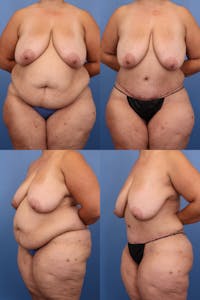 Tummy Tuck Before & After Gallery - Patient 358164 - Image 1