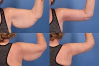 Arm Lift Before & After Gallery - Patient 391506 - Image 1