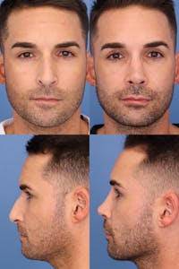 Male Rhinoplasty Before & After Gallery - Patient 724936 - Image 1