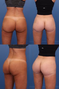 Thong Lift Before & After Gallery - Patient 601107 - Image 1