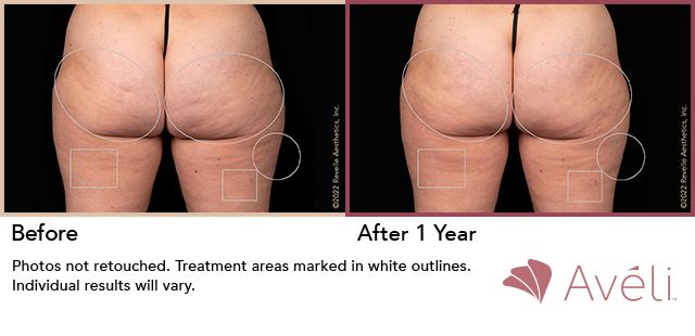Aveli Before & After