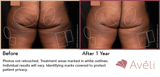 Aveli Before & After