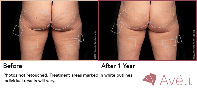 Aveli Before & After