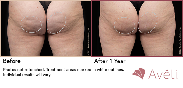 Aveli Before & After