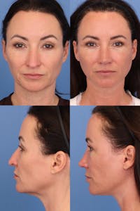 Female Drooping Tip Before & After Gallery - Patient 157361 - Image 1