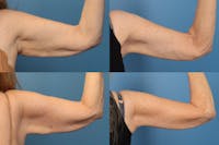 Arm Lift Before & After Gallery - Patient 427019 - Image 1