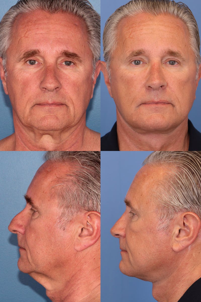 Rhinoplasty 10