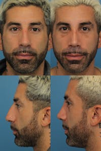 Male Rhinoplasty Before & After Gallery - Patient 392487 - Image 1