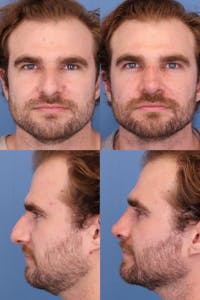Male Rhinoplasty Before & After Gallery - Patient 151780 - Image 1
