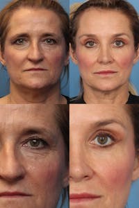 Brow Lift Before & After Gallery - Patient 156392 - Image 1