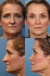 Female Drooping Tip Before & After Gallery - Patient 122932 - Image 1