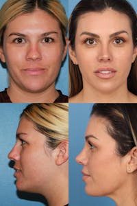 Female Bulbous Tip Before & After Gallery - Patient 265463 - Image 1