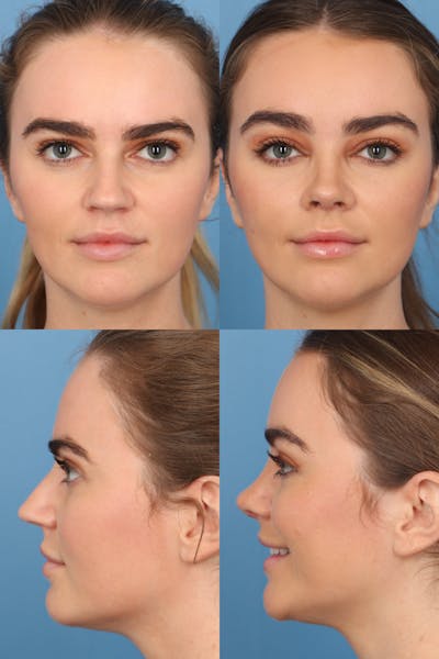 Female Over Projecting Tip Before & After Gallery - Patient 198744 - Image 1