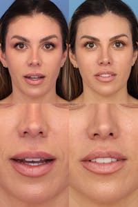 Lip Lift Before & After Gallery - Patient 385290 - Image 1