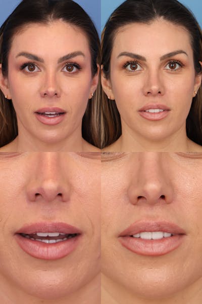 Lip Lift Before & After Gallery - Patient 385290 - Image 1