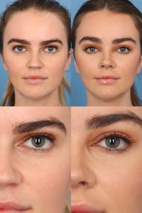 Brow Lift Before & After Gallery - Patient 408617 - Image 1