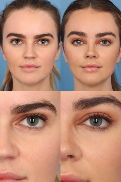 Brow Lift Before & After Gallery - Patient 408617 - Image 1
