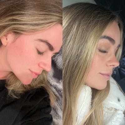 Real Life Patients Before & After Gallery - Patient 417271 - Image 1