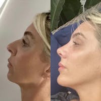 Real Life Patients Before & After Gallery - Patient 376087 - Image 1