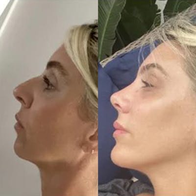 Real Life Patients Before & After Gallery - Patient 376087 - Image 1