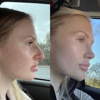 Real Life Patients Before & After Gallery - Patient 361708 - Image 1