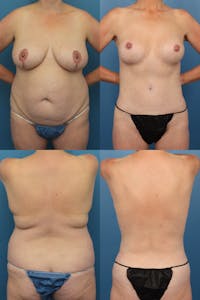 Tummy Tuck Before & After Gallery - Patient 152866 - Image 1