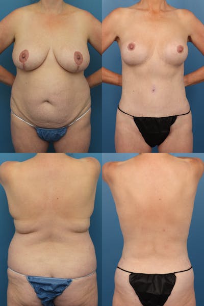 Breast Reduction Before & After Gallery - Patient 578669 - Image 1
