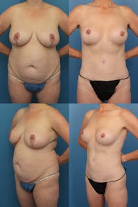Tummy Tuck Before & After Gallery - Patient 242267 - Image 1
