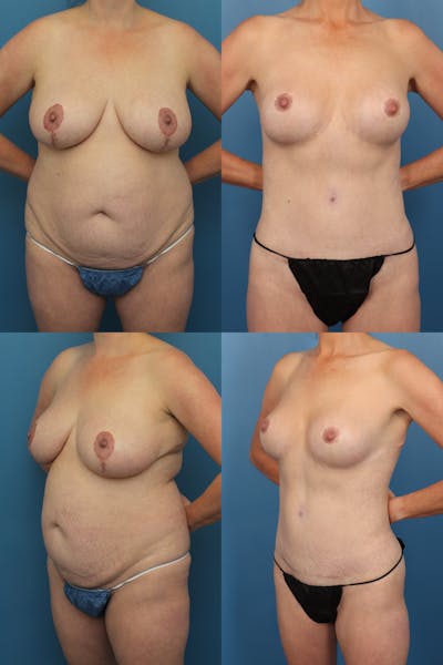 Breast Reduction Before & After Gallery - Patient 407950 - Image 1