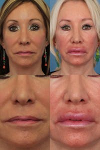 Lip Lift Before & After Gallery - Patient 372747 - Image 1