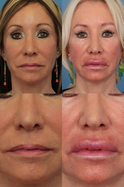 Lip Lift Before & After Gallery - Patient 372747 - Image 1