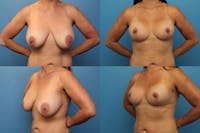 Reductive Augmentation of the Breast Before & After Gallery - Patient 506480 - Image 1