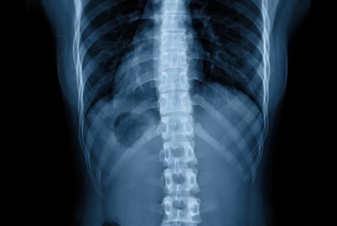 xray of spine