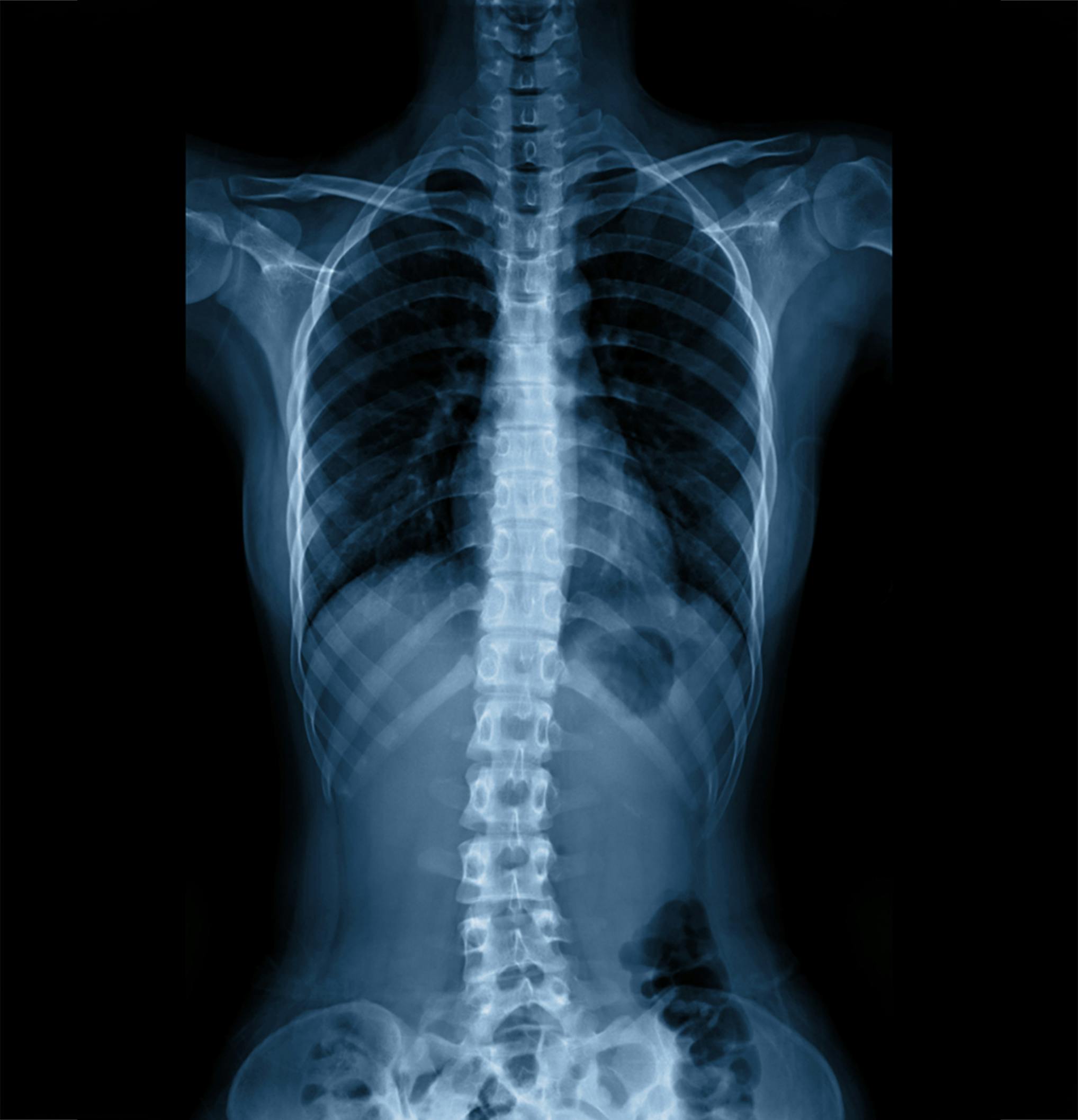 A x-ray of a spine