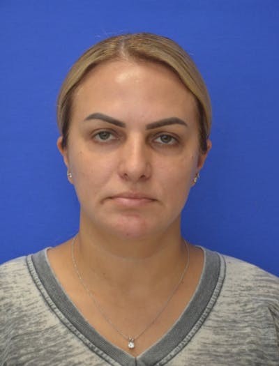 CO2 Before & After Gallery - Patient 286598 - Image 1