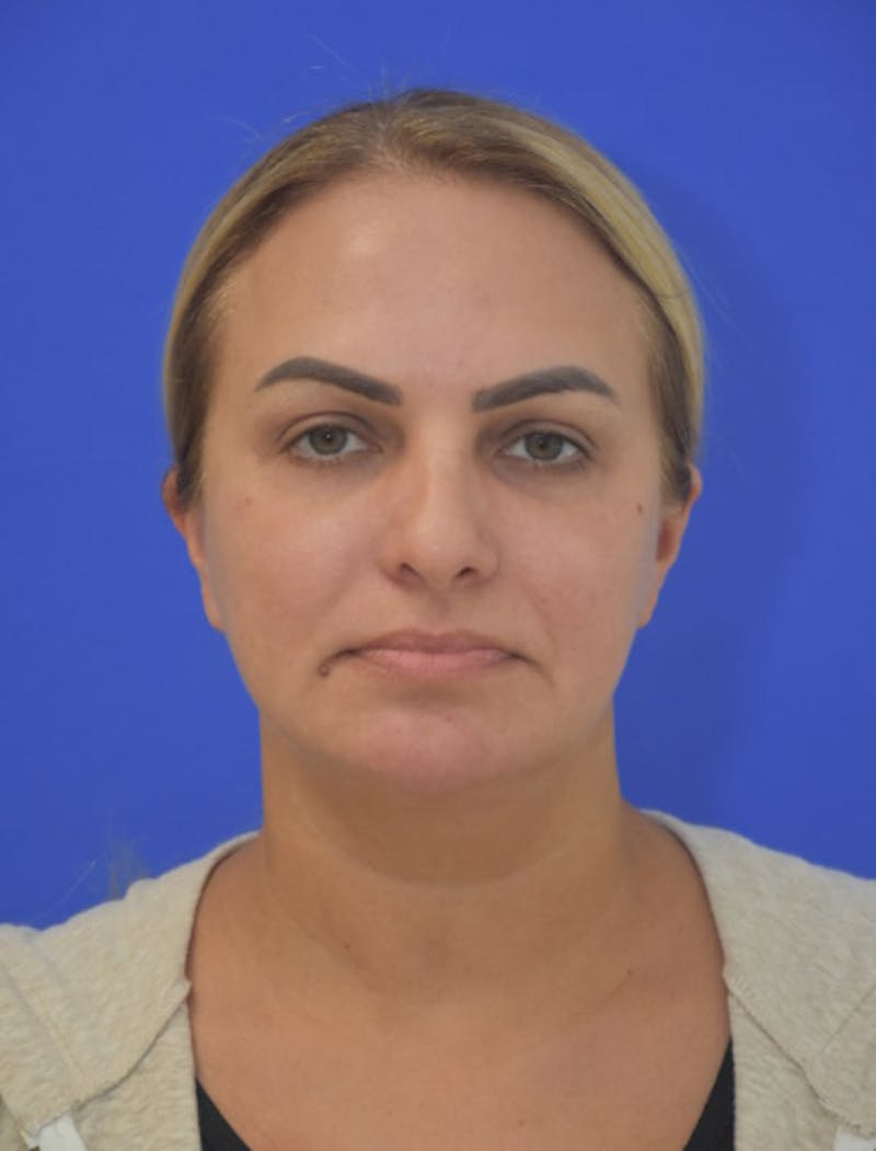 CO2 Before & After Gallery - Patient 286598 - Image 2