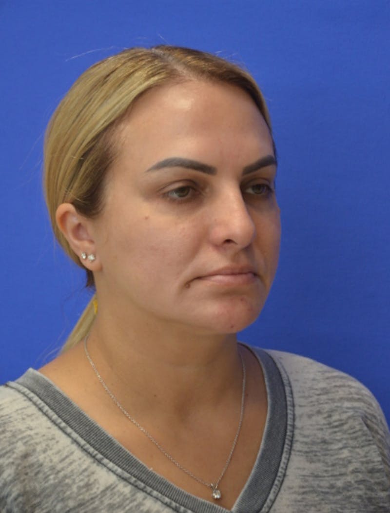 CO2 Before & After Gallery - Patient 286598 - Image 3