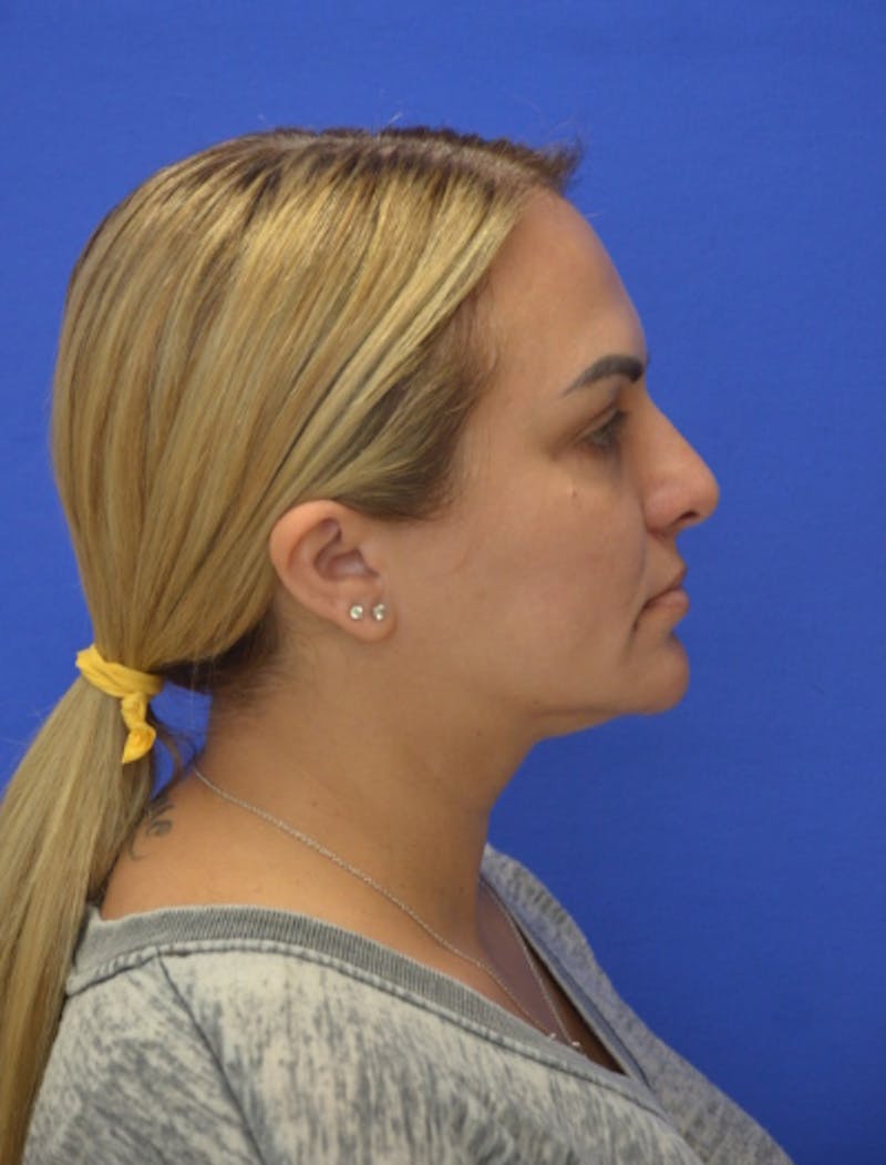 CO2 Before & After Gallery - Patient 286598 - Image 5