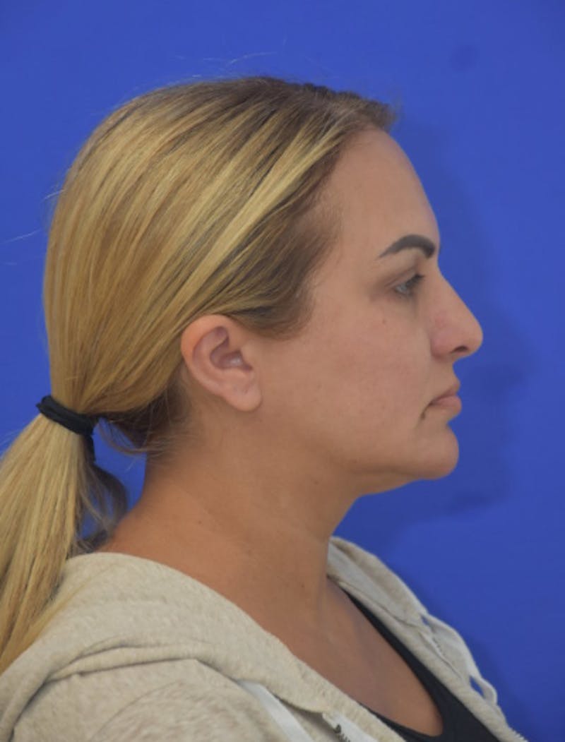 CO2 Before & After Gallery - Patient 286598 - Image 6