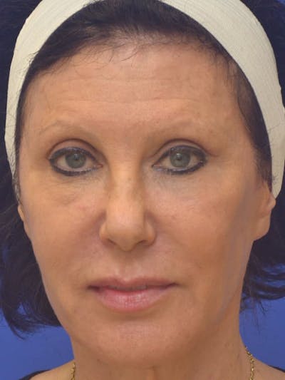 CO2 Before & After Gallery - Patient 131576 - Image 2