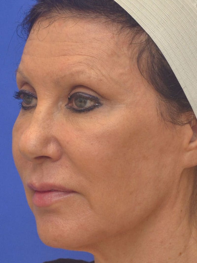 CO2 Before & After Gallery - Patient 131576 - Image 4