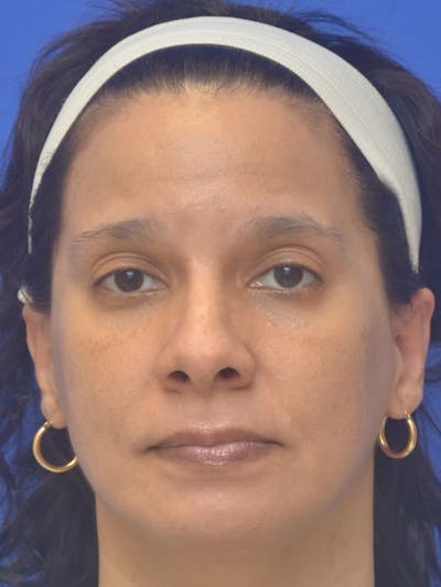 CO2 Before & After Gallery - Patient 366835 - Image 1